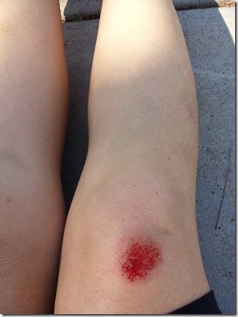 how to run with a bloody  knee (600x800)