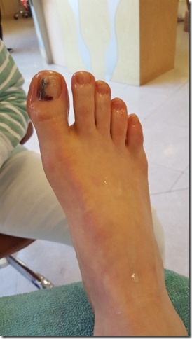 runner problems losing toenails (450x800)