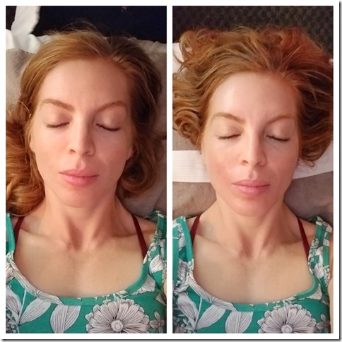 Massage Envy Chemical Peel before after